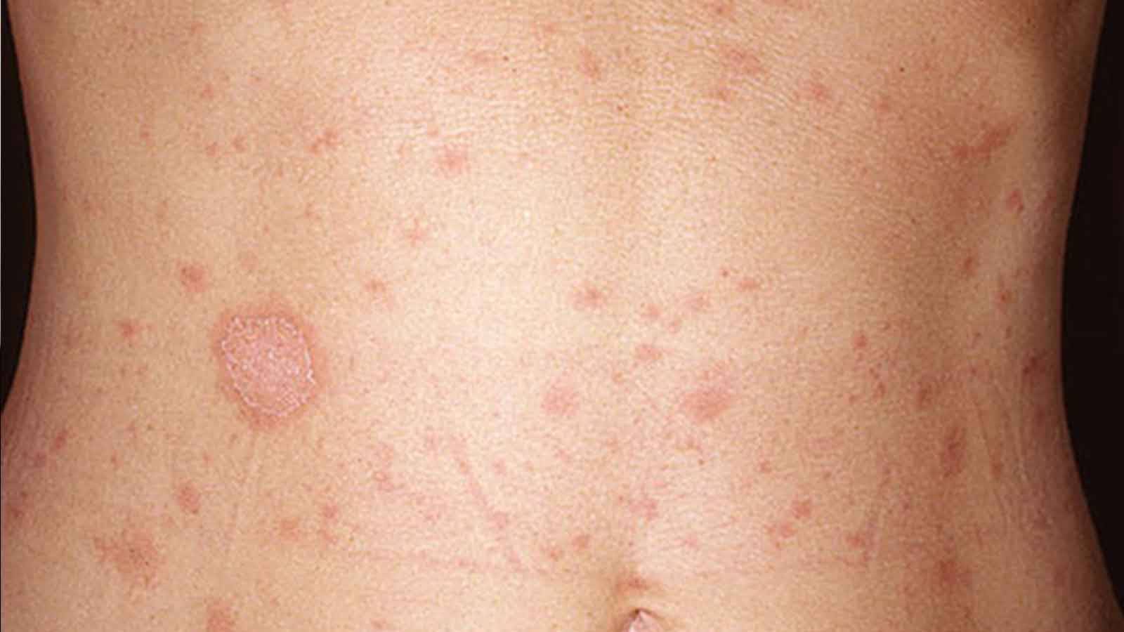 AIDS Belirtileri Deri Döküntüsü