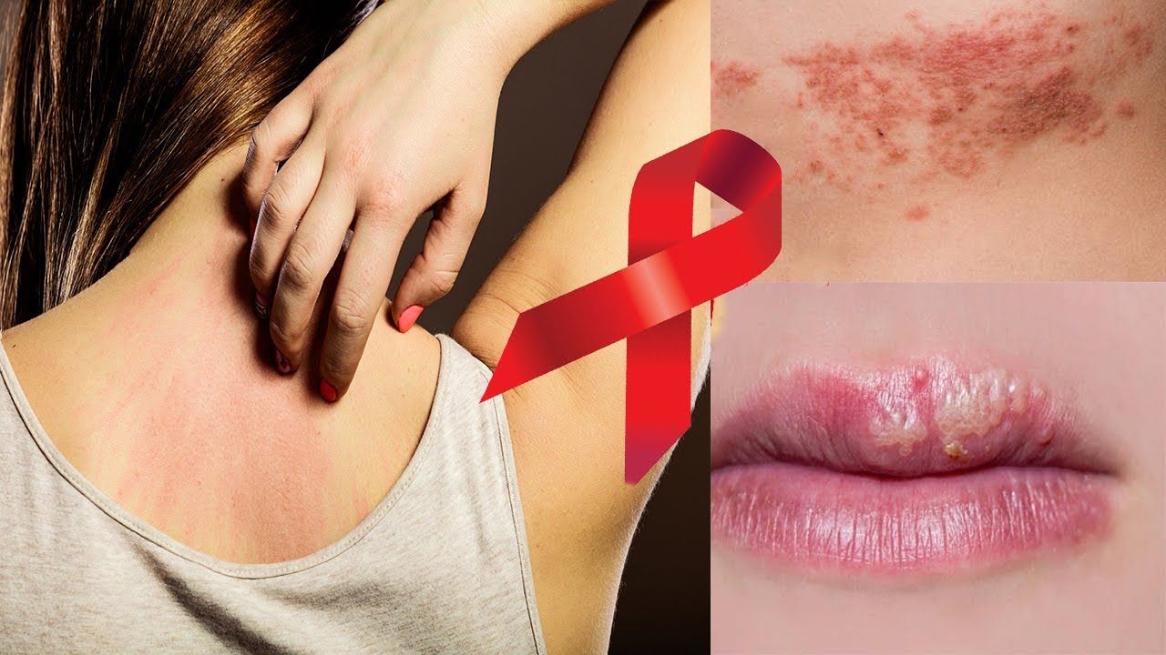AIDS Belirtileri Vücudun Neresinde Başlar?